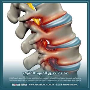 عملية تضييق العمود الفقري