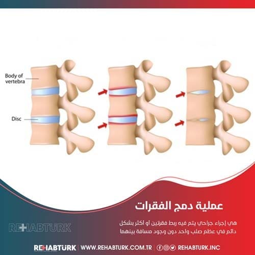 عملية دمج الفقرات في تركيا