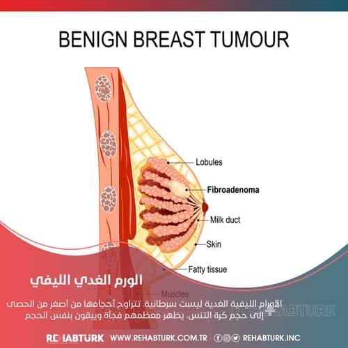 علاج الورم الغدي الليفي في تركيا