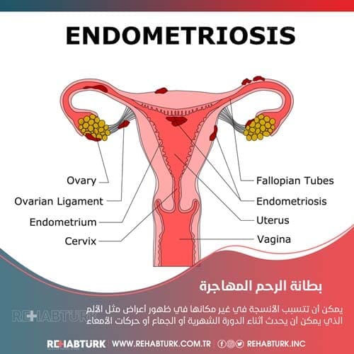 علاج بطانة الرحم المهاجرة في تركيا