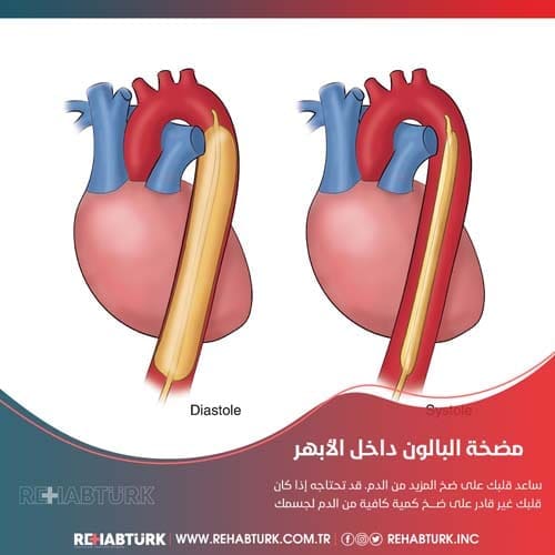 إجراء مضخة البالون داخل الأبهر في تركيا