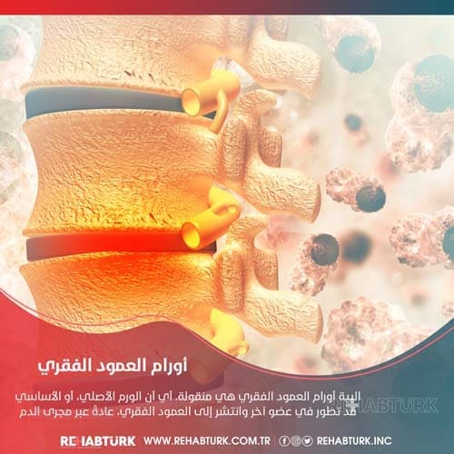 علاج أورام العمود الفقري في تركيا