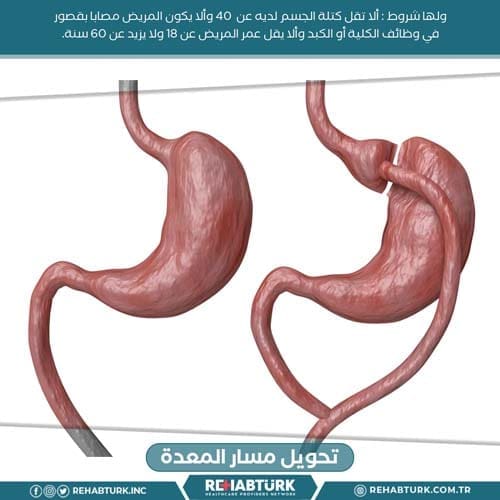 تحويل مسار المعدة في تركيا