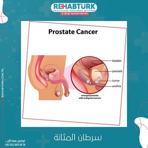 علاج سرطان المثانة في تركيا