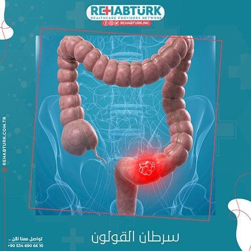 علاج سرطان القولون في تركيا