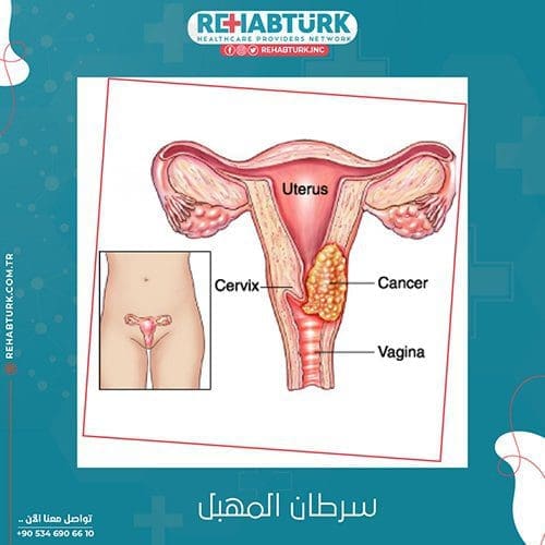 علاج سرطان المهبل في تركيا