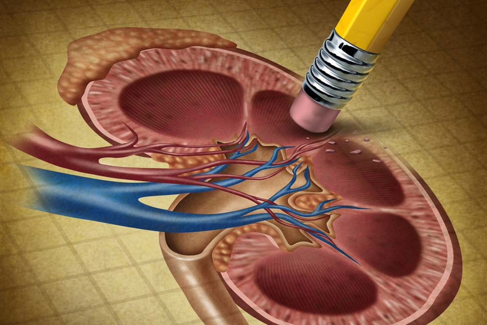 استئصال الكلية (Kidney Removal)