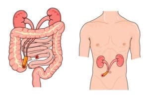 فغر الجهاز البولي (Urostomy)