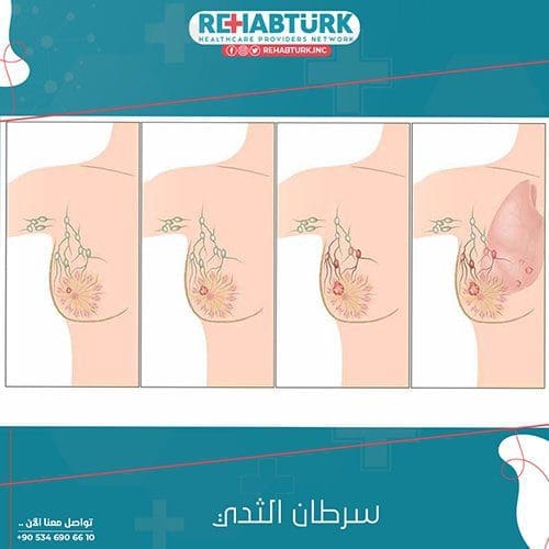 علاج سرطان الثدي في تركيا