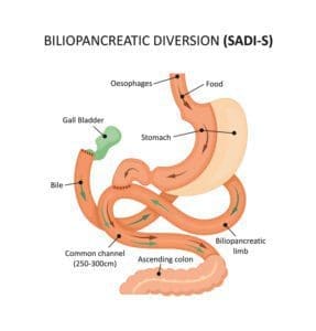 Biliopancreatic diversion (sadi-s). Gastric bypass. Vector illustration