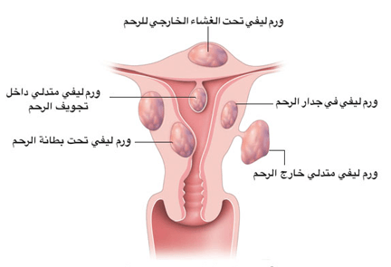 الاورام الليفية