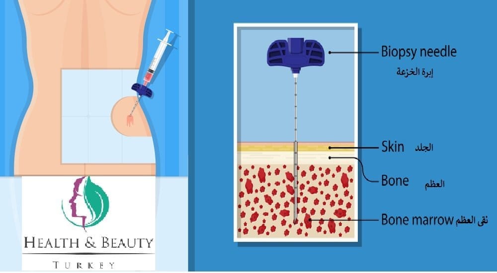 bone marrow biopsy