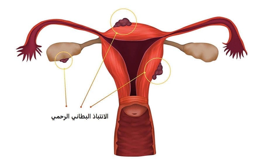 استئصال الرحم في تركيا