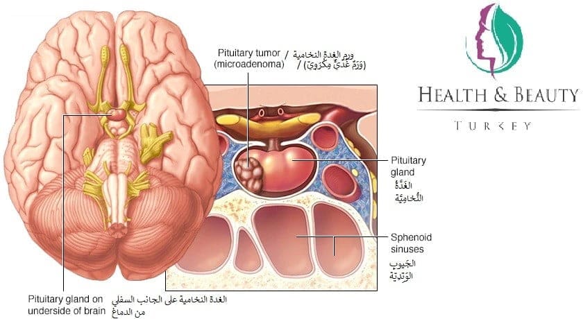 ورم الغدة النخامية 