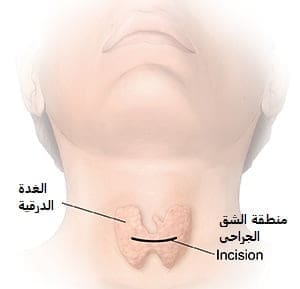 استئصال الغدة الدرقية