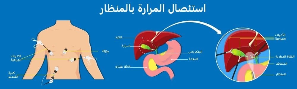 استئصال المرارة بالمنظار