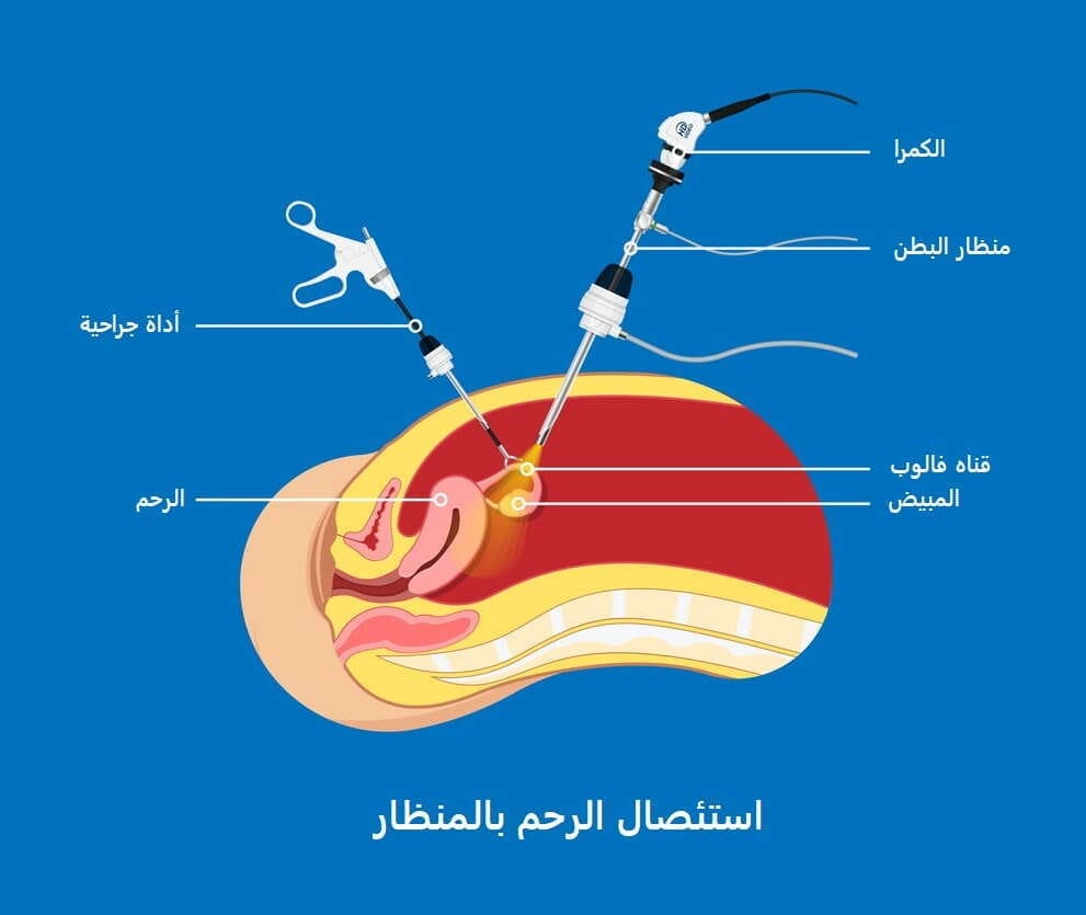 استئصال الرحم بالمنظار