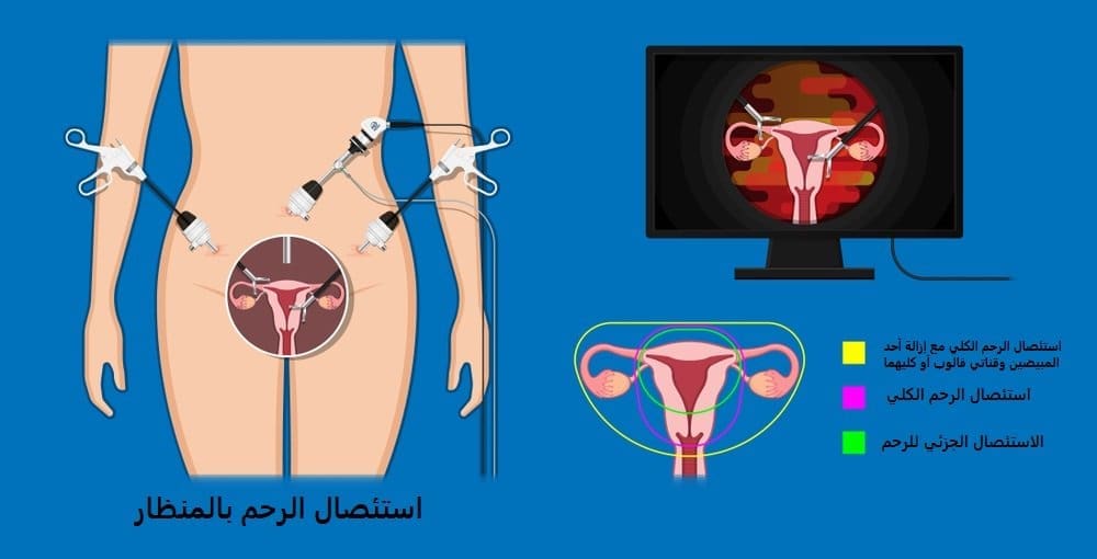 استئصال الرحم بالمنظار