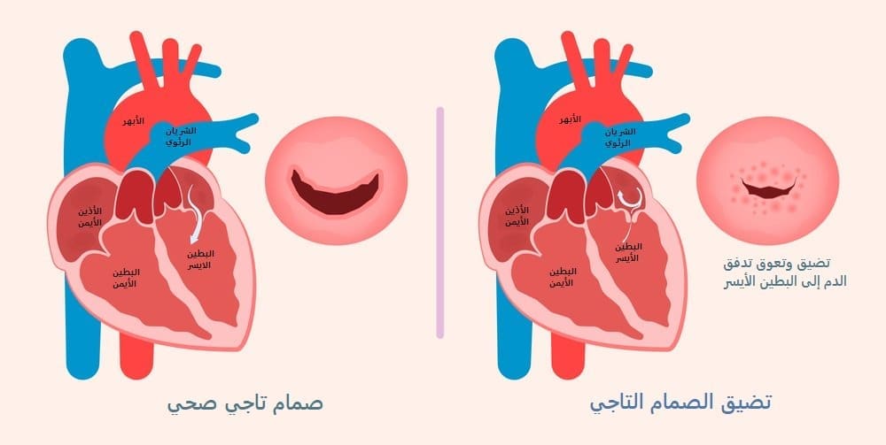 تضيق الصمام التاجي