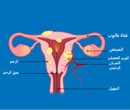 الورم العضلي