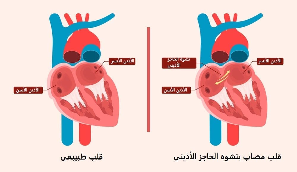 تشوه الحاجز الأذيني