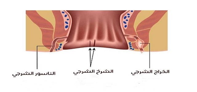 علاج الناسور الشرجي في تركيا