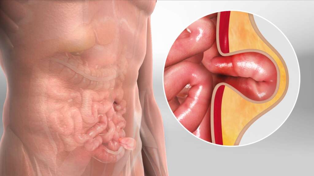 الفتق الجراحي (Incisional Hernias)