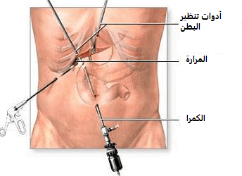 استئصال المرارة