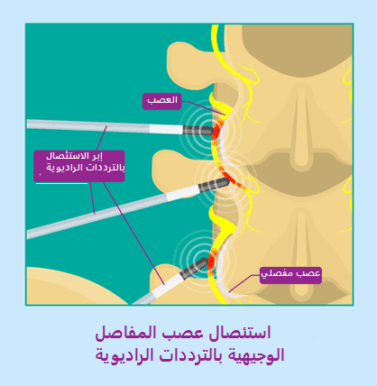 استئصال عصب المفاصل الوجيهية