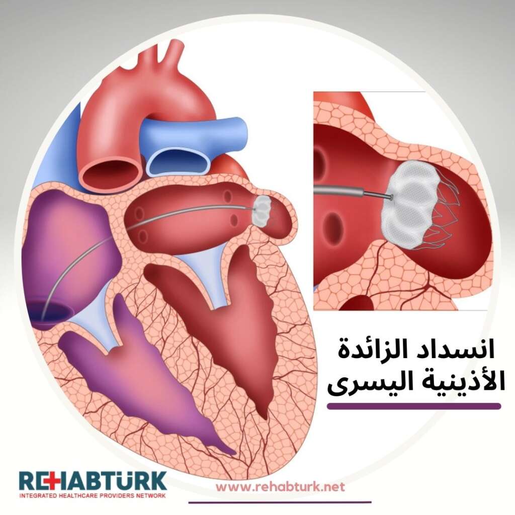 إغلاق الملحق الأذيني الأيسر 