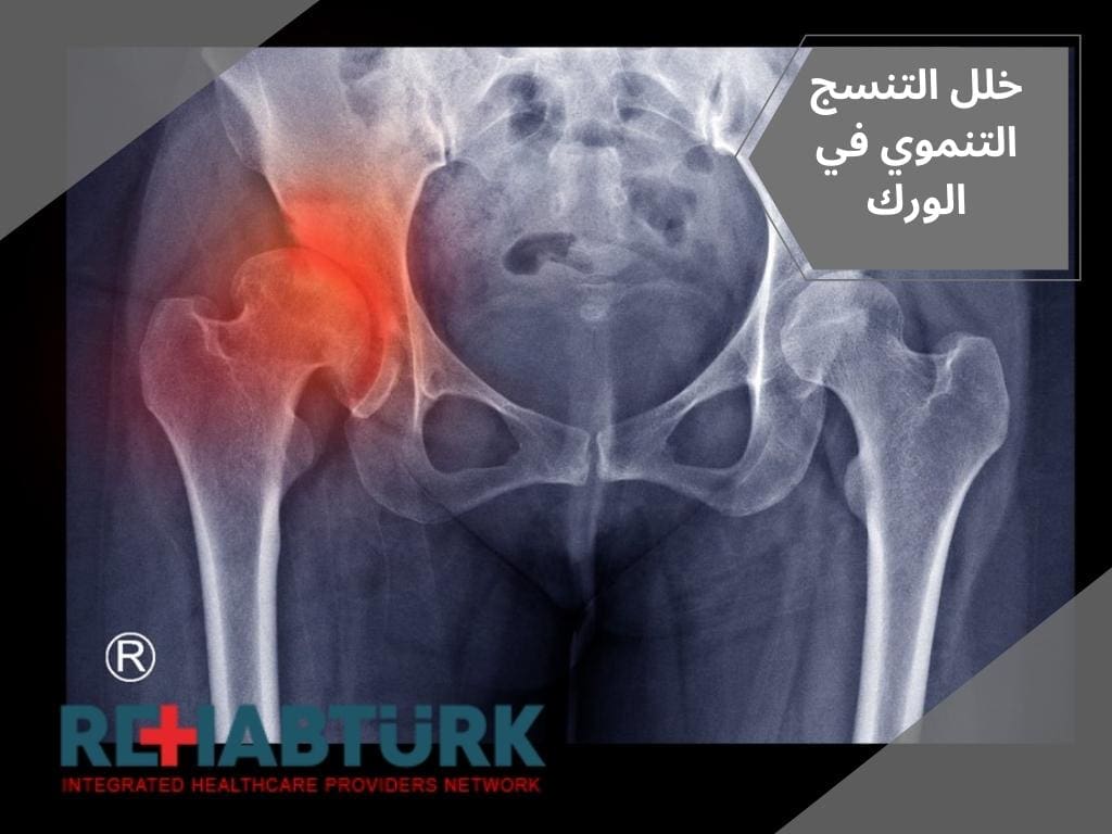 خلل التنسج التنموي في الورك و علاجه خلل التنسج التنموي في الورك خلل التنسج الوركي