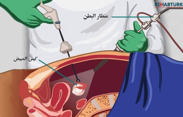 جراحة كيس المبيض: كل ما تحتاج لمعرفته