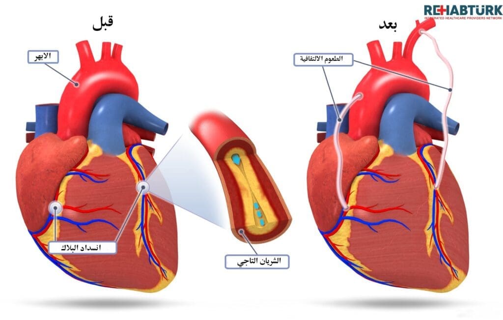 زراعة الشرايين التاجية و تغير الشرايين