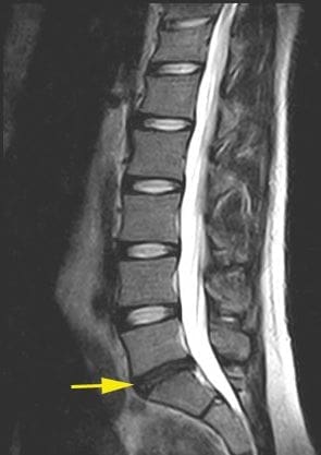 قرص بين فقري متآكل به القليل من المحتوى السائل. © joint-surgeon جراحة العمود الفقري القطني في تركيا