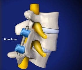 هناك تاريخ طويل لجراحة دمج الأجسام الفقرية لضبط موضع الفقرات المنزاحة. © Viewmedica دمج الفقرات في تركيا