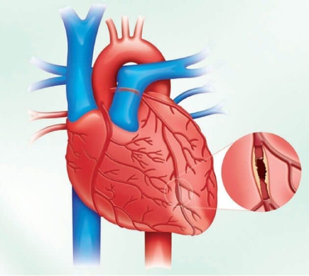 أنواع عمليات القلب المتوفرة في تركيا أنواع عمليات القلب أنواع عمليات القلب المتوفرة في تركيا