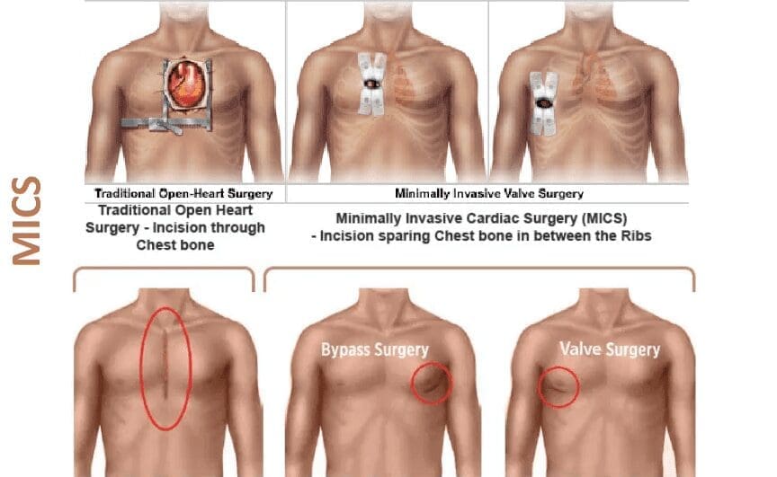 عملية القلب المفتوح، طريقة الإجراء  والمخاطر المحتملة في تركيا