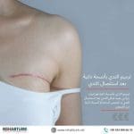 ترميم الثدي بأنسجة ذاتية بعد استئصال الثدي في تركيا