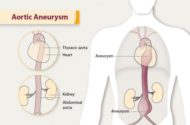 3 طرق لعلاج تمدد الشريان الأورطي البطني