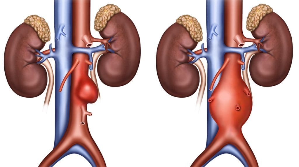 3 طرق لعلاج تمدد الشريان الأورطي البطني