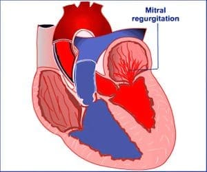 3 طرق لعلاج القلس المترالي