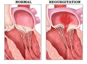 3 طرق لعلاج القلس المترالي