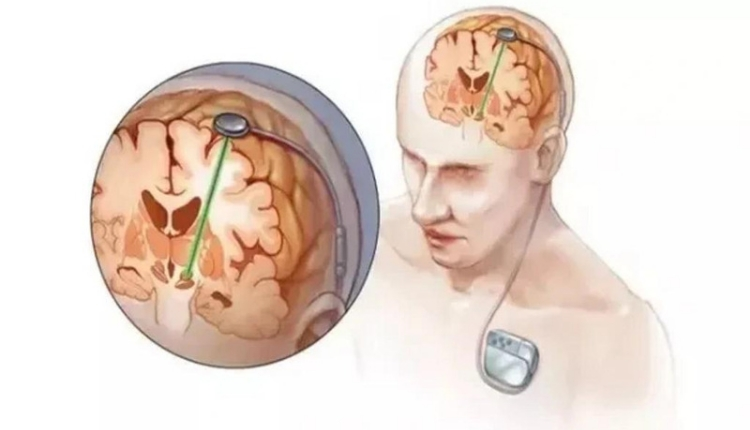 جراحة استئصال الفص الصدغي لعلاج نوبات الصرع 2022