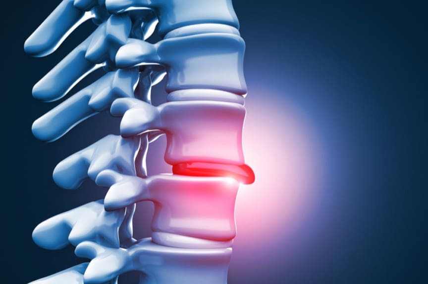 افضل طرق لعلاج مرض القرص المنفتق 2022