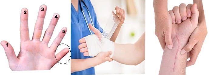ترميم اليد (ترميم اليدين) لاستعادة وظائفها 2022