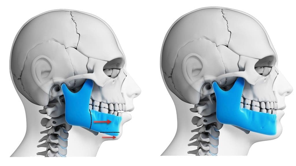  جراحة الفك التجملية و التقومية 2022