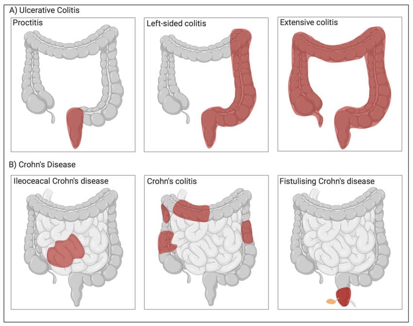 مرض التهاب الأمعاء (IBD) الاختبارات والتشخيص