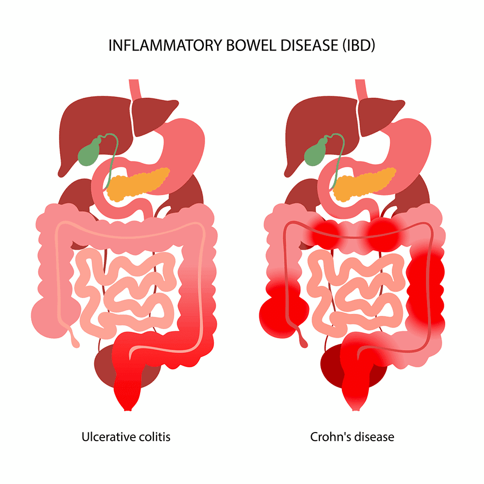 مرض التهاب الأمعاء (IBD) الاختبارات والتشخيص