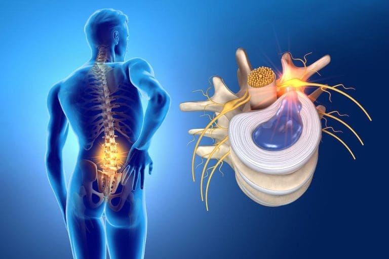 فتق القرص القطني وخيارات العلاج فتق القرص القطني فتق القرص القطني وخيارات العلاج