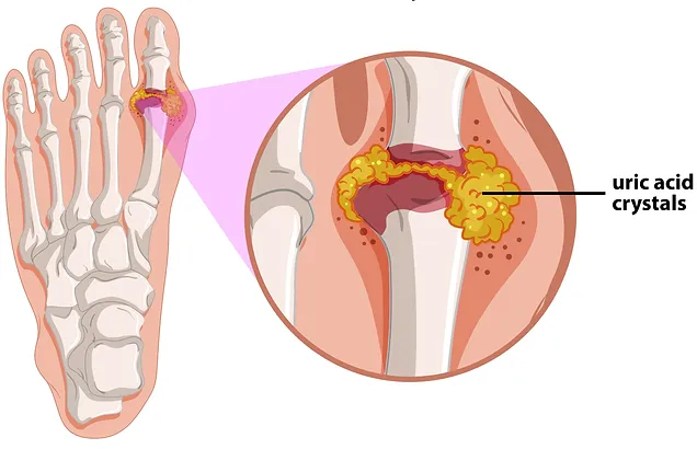 ما هو مرض النقرس وما هي طرق العلاج؟